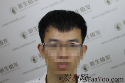 杭州新生植发1500单位，额头变小帅气变大