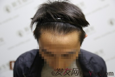 广州新生植发，不用羡慕别人的发际线了别人有的你也可以有