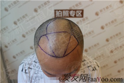 广州新生植发：中年脱发不用怕，改变“门面”就现在