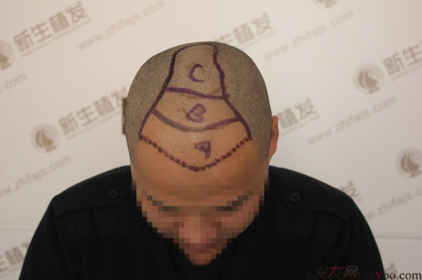 南京新生植发医院，让我的头发“化腐朽为神奇”