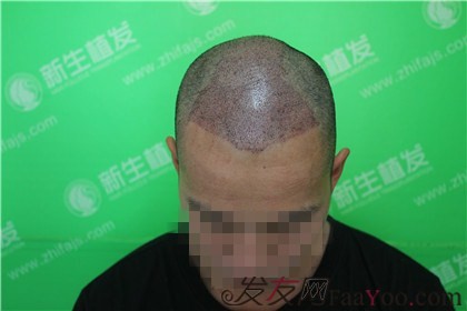 杭州新生植发：终于帮助我摆脱多年的脱发困扰了