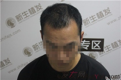 杭州新生植发：终于帮助我摆脱多年的脱发困扰了