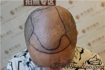 广州新生植发医院，“段先生”的大叔形象改造