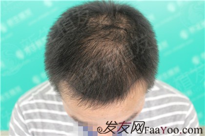 广州新生植发案例，趁着年轻奋斗但别忘了你的身体