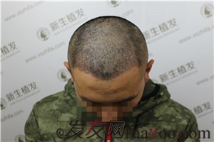 额角后退留长发欲盖弥彰？有广州新生在不用怕这些