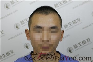 额角后退留长发欲盖弥彰？有广州新生在不用怕这些