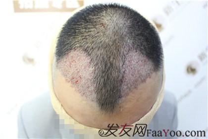 杭州新生植发：把我的面子找了回来从此不再脱发