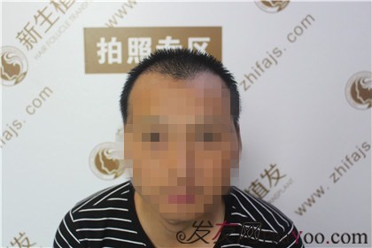 杭州新生植发：把我的面子找了回来从此不再脱发