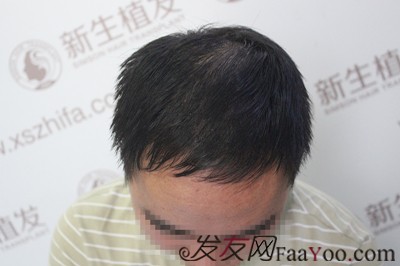 广州新生植发1500毛囊，让我的额角布满秀发