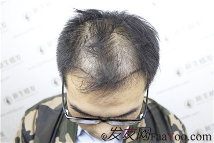 在广州新生植发，摆脱脱发烦恼，颜值上升很轻松！
