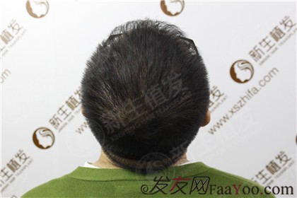 在广州新生植发，摆脱脱发烦恼，颜值上升很轻松！