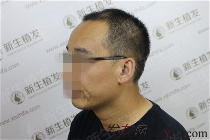  广州新生植发4500毛囊单位，重塑形象小意思！