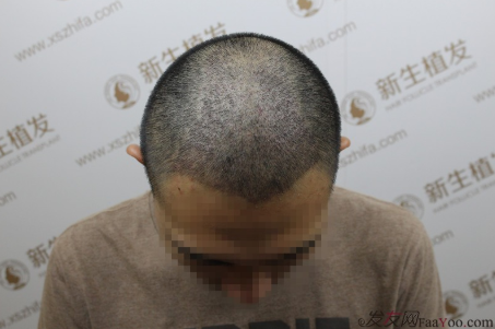 之前我在南京新生植了发，现在我来汇报一下植发前后的改变