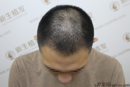之前我在南京新生植了发，现在我来汇报一下植发前后的改变