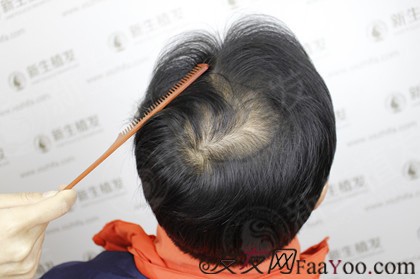 在广州新生植发3200毛囊单位，结果令人难以置信
