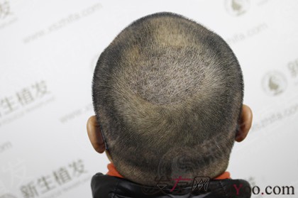 在广州新生植发3200毛囊单位，结果令人难以置信
