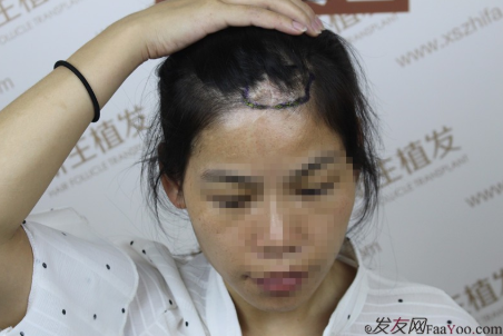 在南京新生植发后，终于告别了我头上的疤 心中的刺！