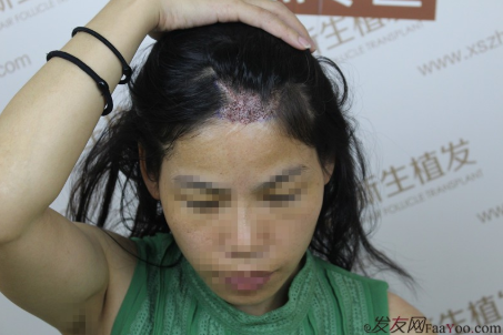 在南京新生植发后，终于告别了我头上的疤 心中的刺！