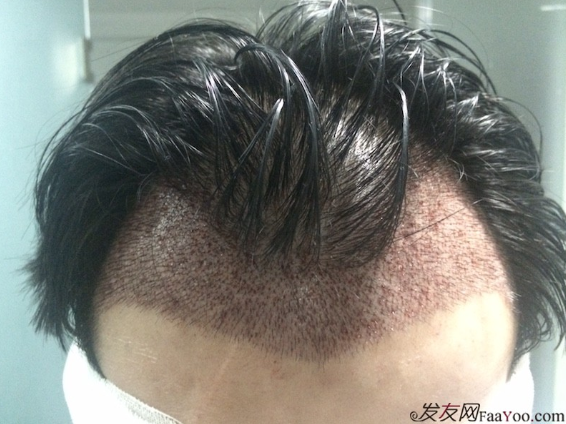 在深圳大麦微针植发2500单位后，期待额角头发能茁壮成长