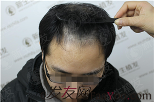 广州新生植发3000单位，彻底丢掉“脱发”的标签！