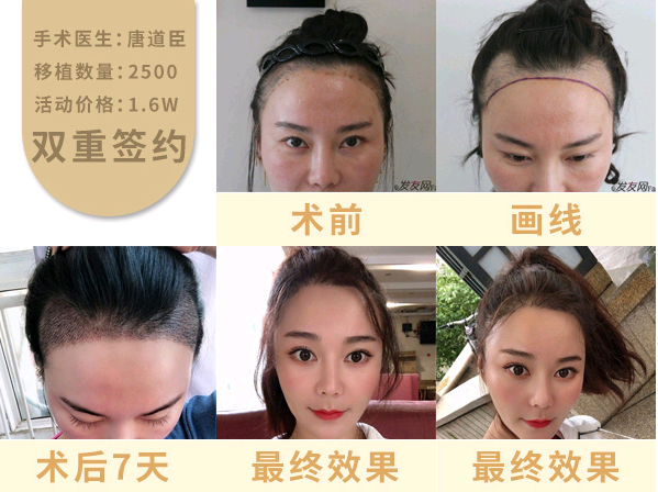 女性移植头发后什么样