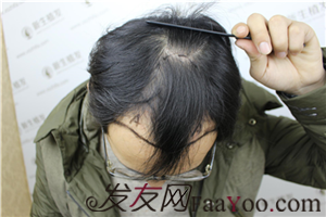 广州新生植发2500毛囊单位，让你的脱发失而复得