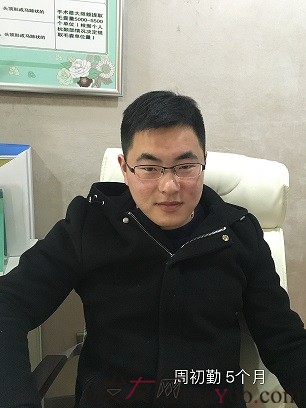 脱发多年，在南京植发医院种植2000多单位，说说我的经历