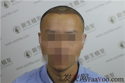 广州新生植发3200毛囊单位，4个月后“大秃”变“大帅”