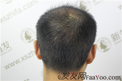 广州新生植发3200毛囊单位，4个月后“大秃”变“大帅”