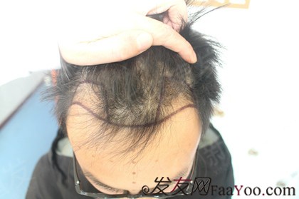 广州新生植发1500毛囊单位，带你从“头”改变