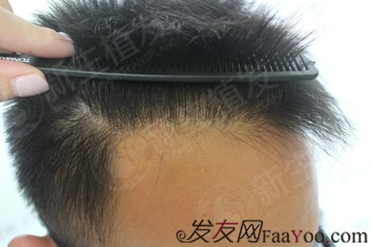 广州新生植发1500毛囊单位，带你从“头”改变