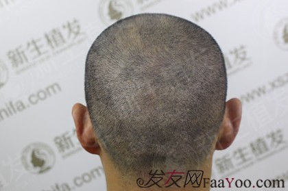 广州新生植发3200毛囊单位，重塑老板好形象！