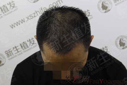 广州新生植发3200毛囊单位，重塑老板好形象！