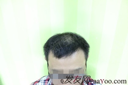 广州新生植发3000单位，与秃发区域彻底说拜拜