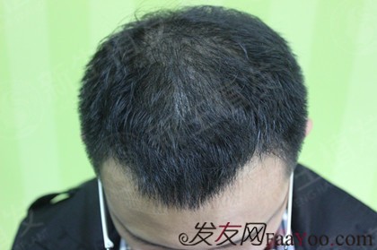 广州新生植发3000单位，与秃发区域彻底说拜拜