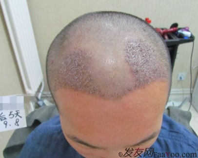 在武汉碧莲盛植发六个月，这效果是什么水平