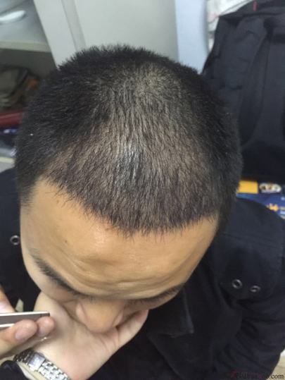 我在上海大麦微针植了发，看看我的心路历程