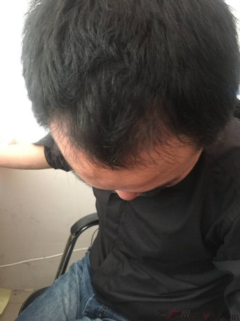 我在上海大麦微针植了发，看看我的心路历程