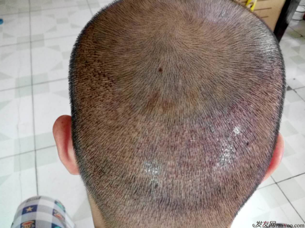 植发附近皮肤水肿了(植发后的水肿要多久才能消失)
