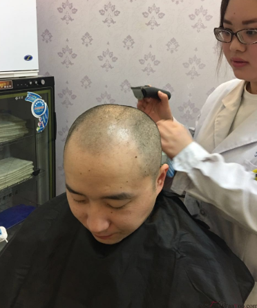 三级脱发植发，在郑州大麦微针植发2700pse+200ptt+st 