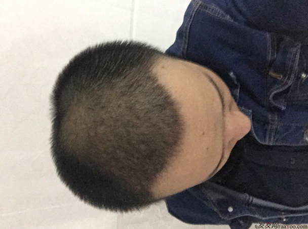 三级脱发植发，在郑州大麦微针植发2700pse+200ptt+st 