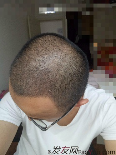 我在青岛大麦微针植了发，3600单位期待我的蜕变