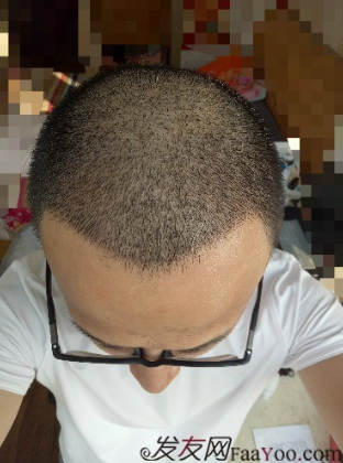 我在青岛大麦微针植了发，3600单位期待我的蜕变