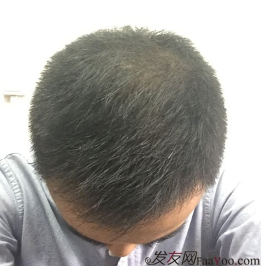 长沙大麦微针植发3510单位，一步步变帅的过程