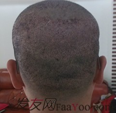 深圳大麦微针2430单位，植发前前后后记录对比