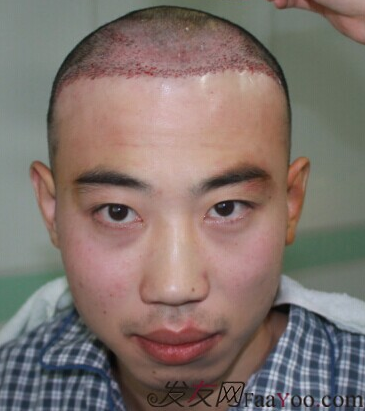 在雍禾发际线额头植发手术，露脸了也无所谓