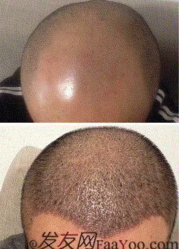 3级脱发植发经历，大麦微针植发之大叔的褪变