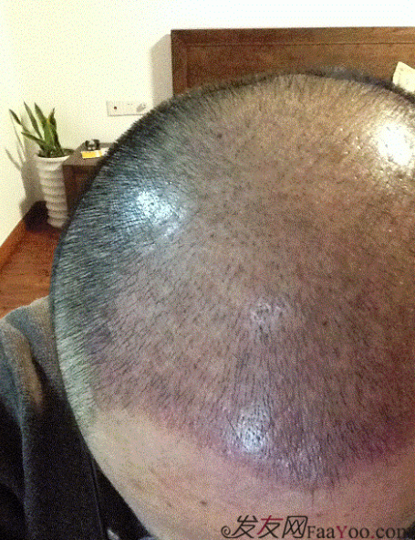 3级脱发植发经历，大麦微针植发之大叔的褪变