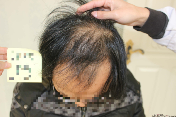 杭州大麦微针3200单位，看自己头发逐渐变化很开心