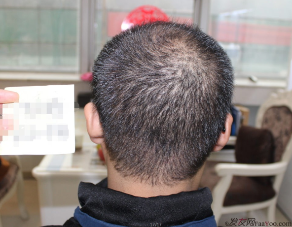 杭州大麦微针3200单位，看自己头发逐渐变化很开心